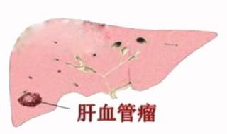 海绵状血管瘤治疗多少钱 治血管瘤要多少钱